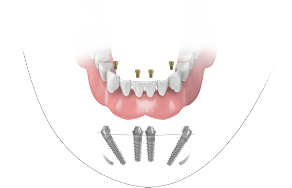 Illustration of an All-on-4 fixed bridge supported by four angled dental implants