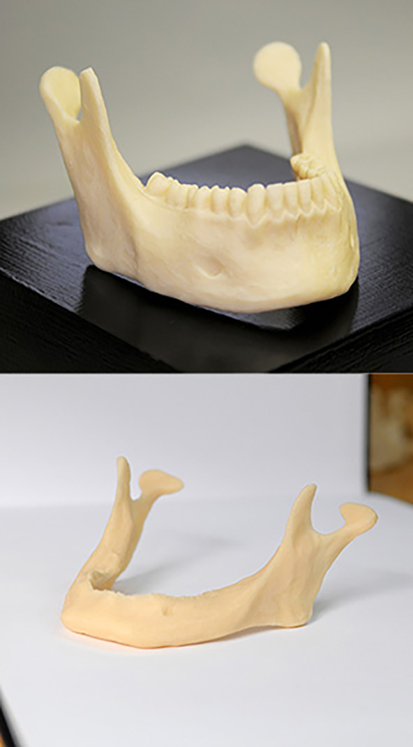 Comparison of healthy jawbone versus bone loss after missing teeth