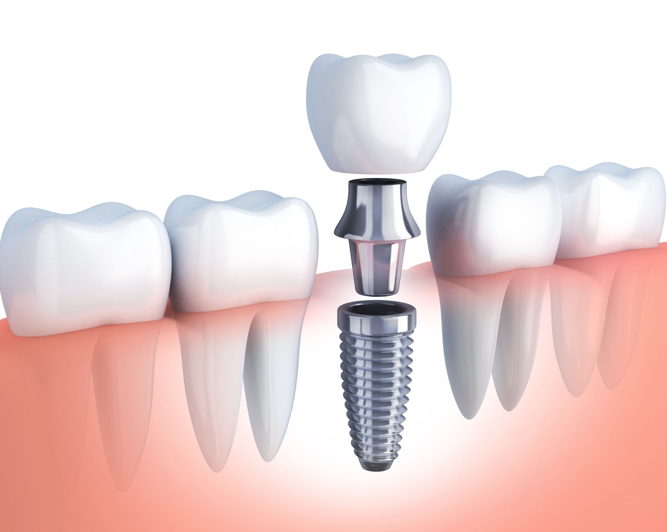 The three parts of a dental implant: titanium post, abutment, and crown