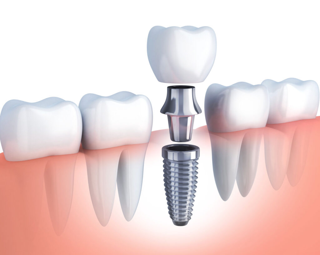 the three-parts of a dental implant